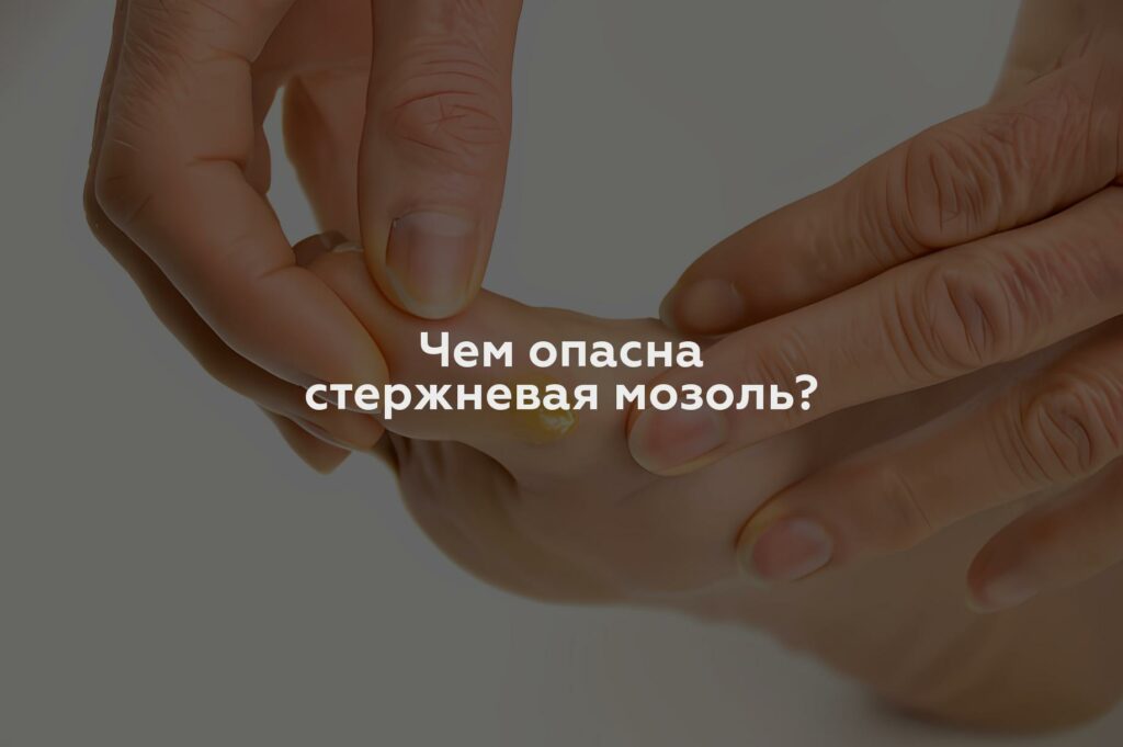 Чем опасна стержневая мозоль?