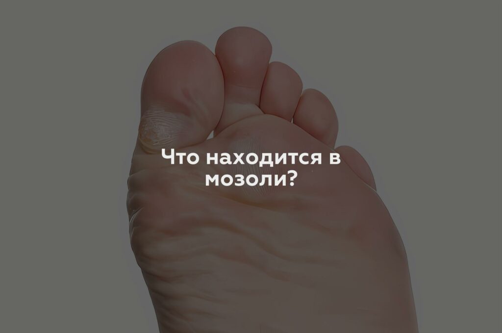 Что находится в мозоли?