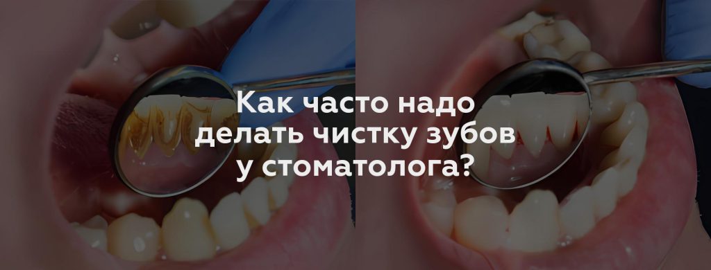 Как часто надо делать чистку зубов у стоматолога?