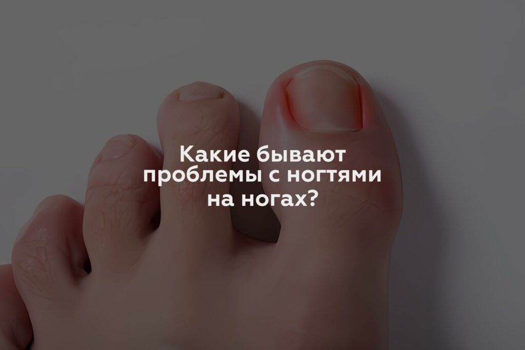 Какие бывают проблемы с ногтями на ногах?