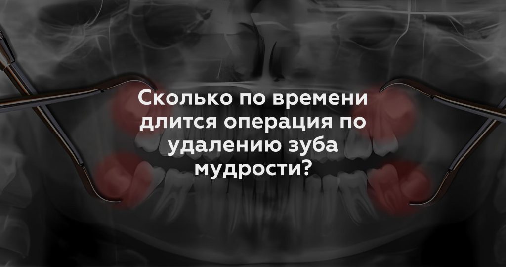 Сколько по времени длится операция по удалению зуба мудрости?