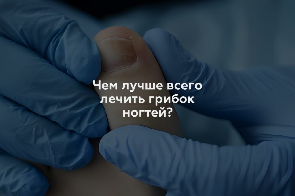 Чем лучше всего лечить грибок ногтей?