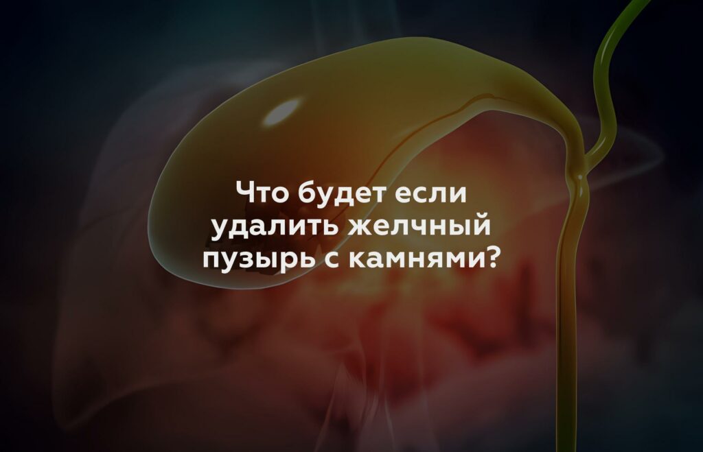 Что будет если удалить желчный пузырь с камнями?