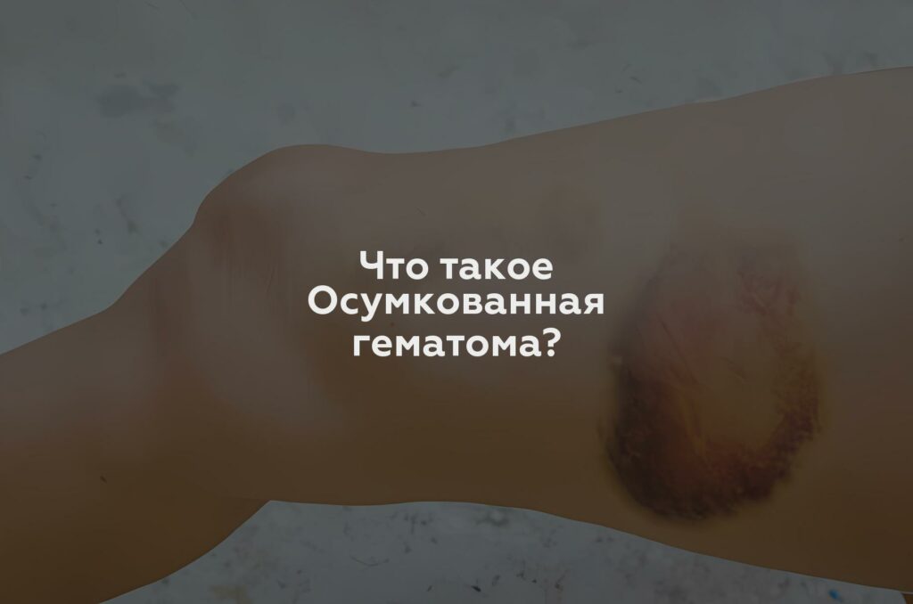 Что такое Осумкованная гематома?