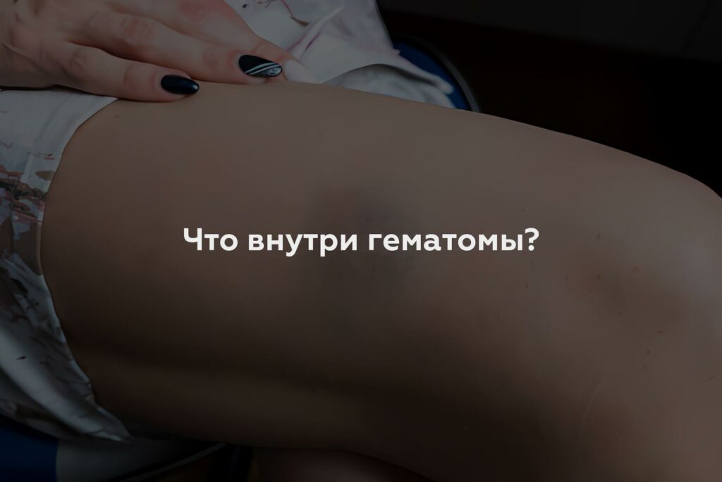 Что внутри гематомы?