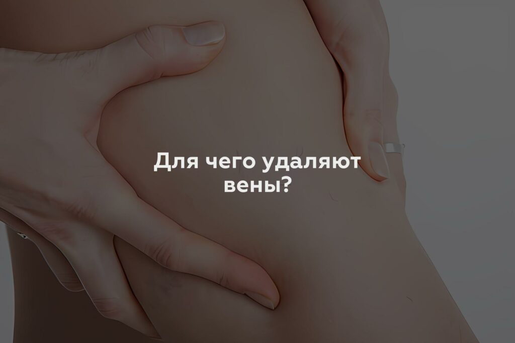 Для чего удаляют вены?