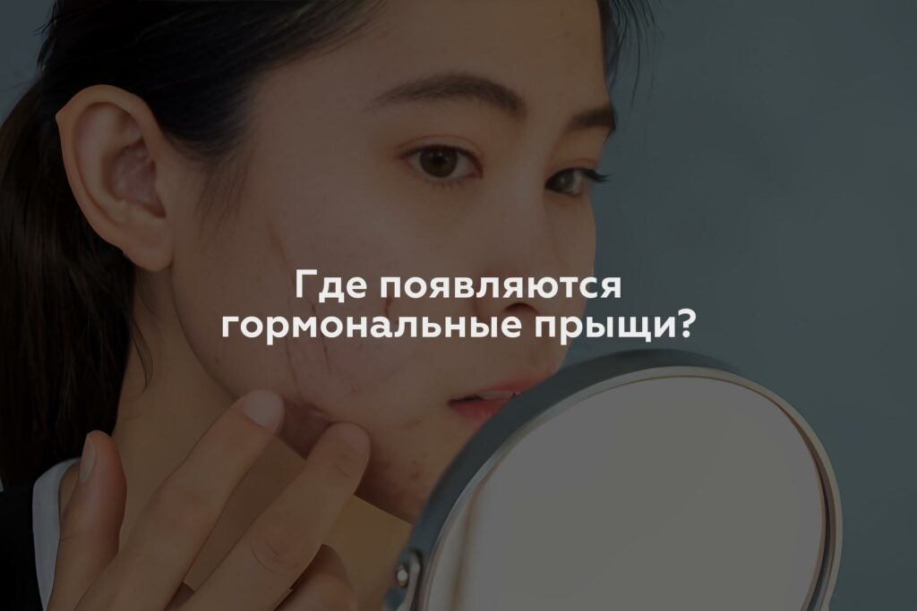 Где появляются гормональные прыщи?