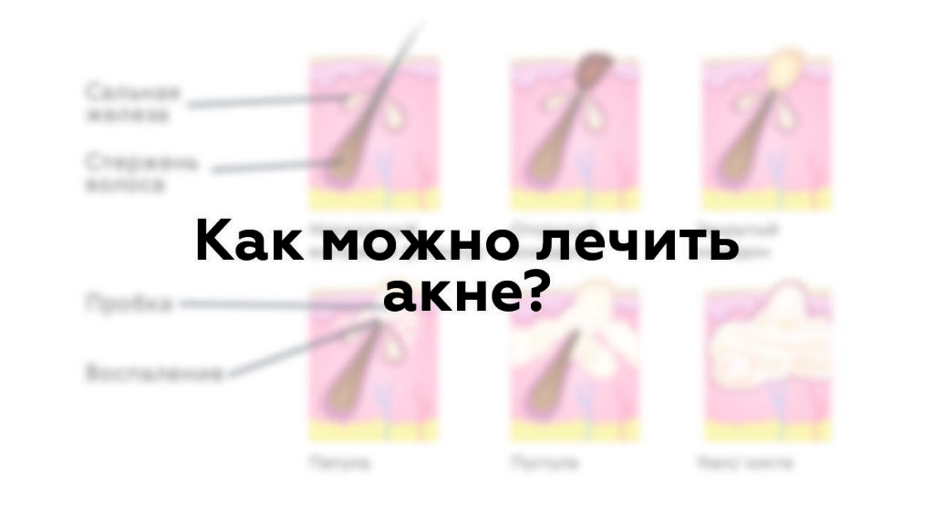 Как можно лечить акне?