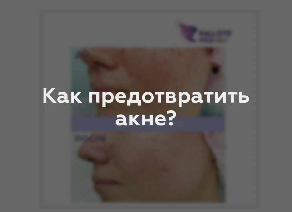 Как предотвратить акне?