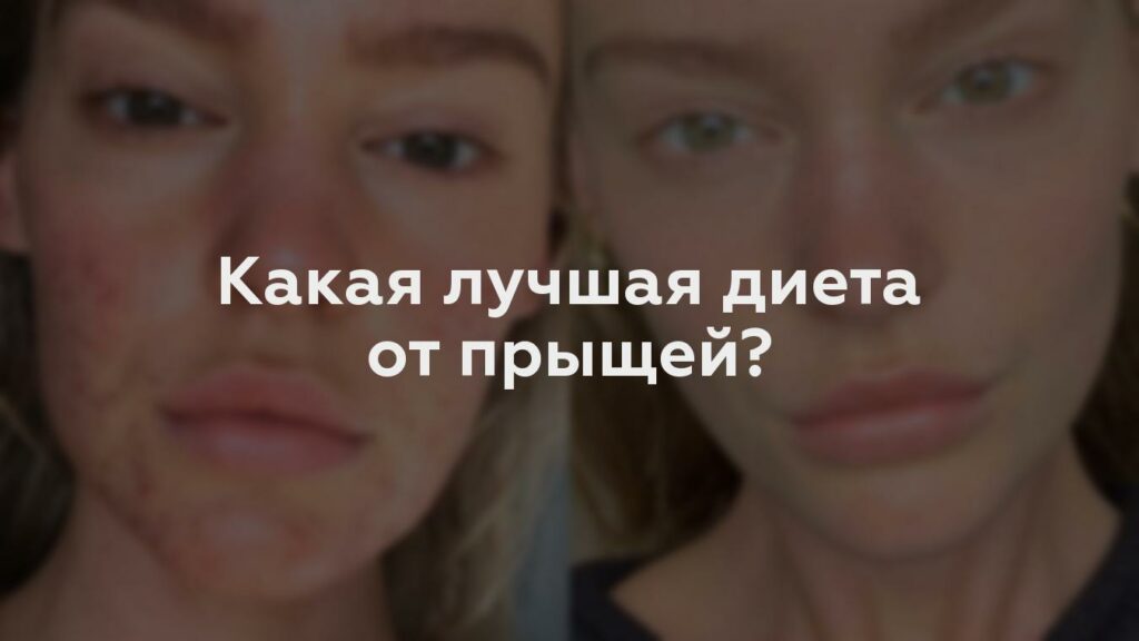 Какая лучшая диета от прыщей?