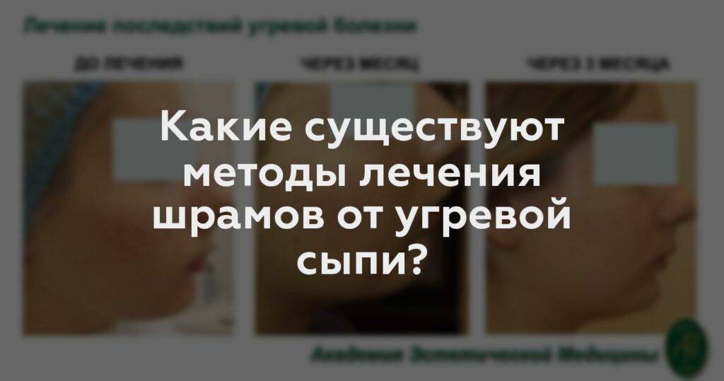 Какие существуют методы лечения шрамов от угревой сыпи?