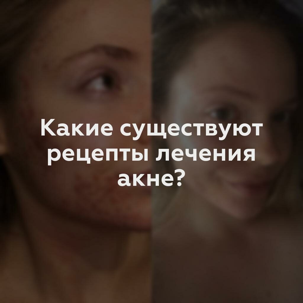 Какие существуют рецепты лечения акне?