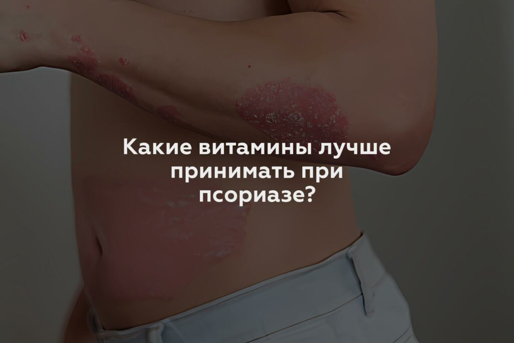 Какие витамины лучше принимать при псориазе?