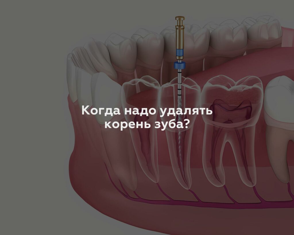 Когда надо удалять корень зуба?