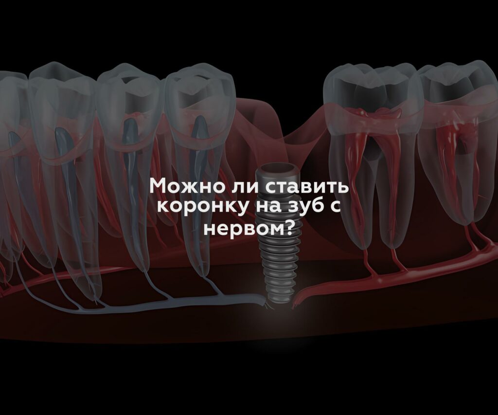 Можно ли ставить коронку на зуб с нервом?