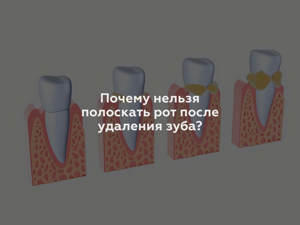 Почему нельзя полоскать рот после удаления зуба?