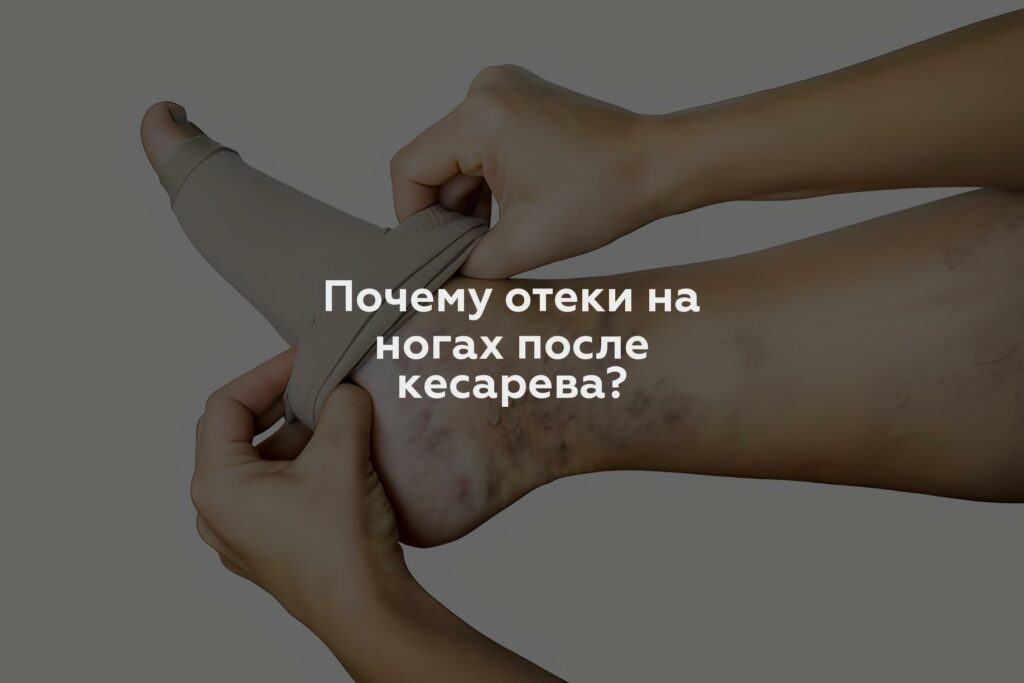 Почему отеки на ногах после кесарева?