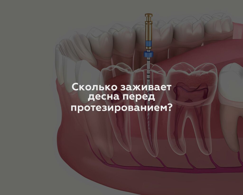 Сколько заживает десна перед протезированием?