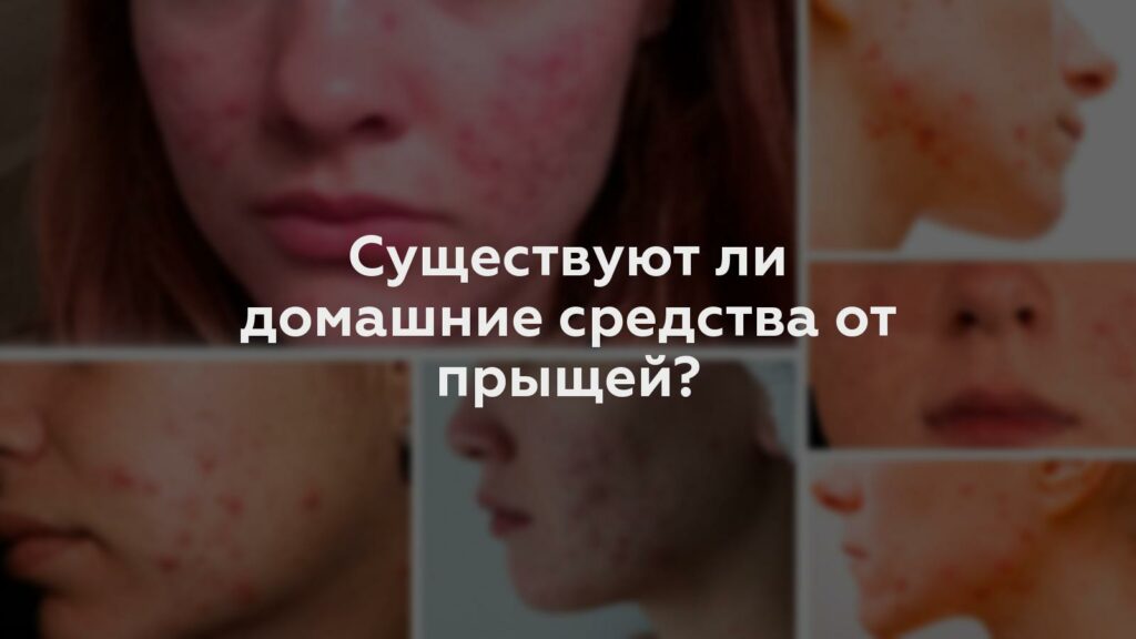 Существуют ли домашние средства от прыщей?