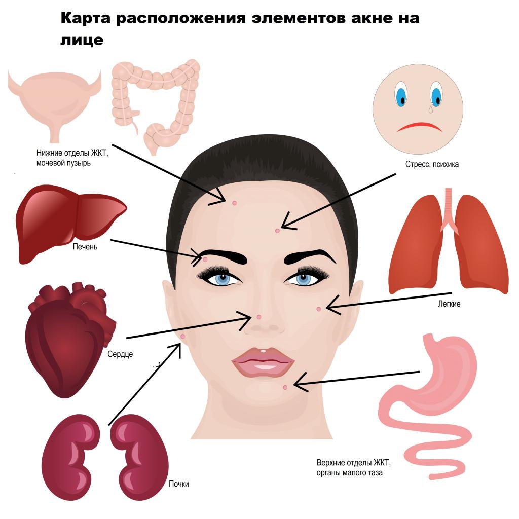 В чем причина акне?