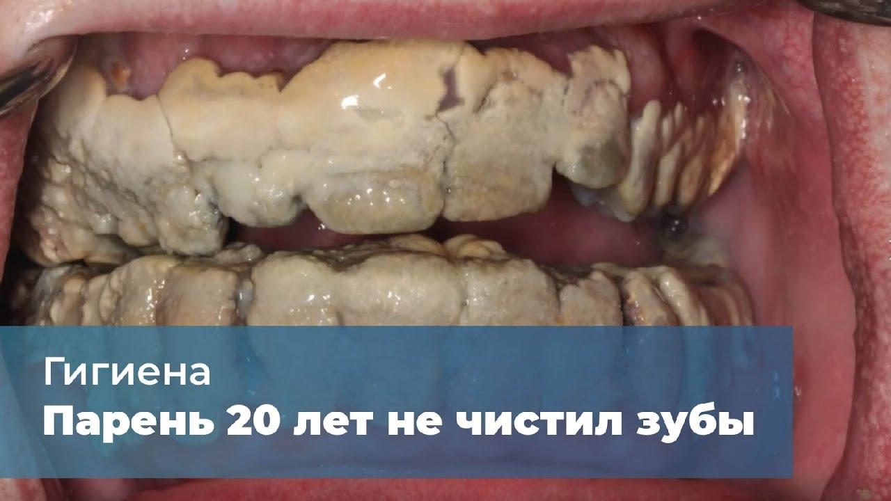 Что будет если 5 дней не чистить зубы?