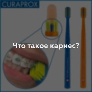 Что такое кариес?