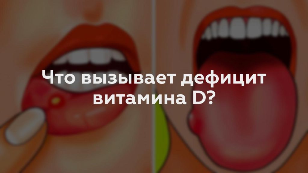 Что вызывает дефицит витамина D?