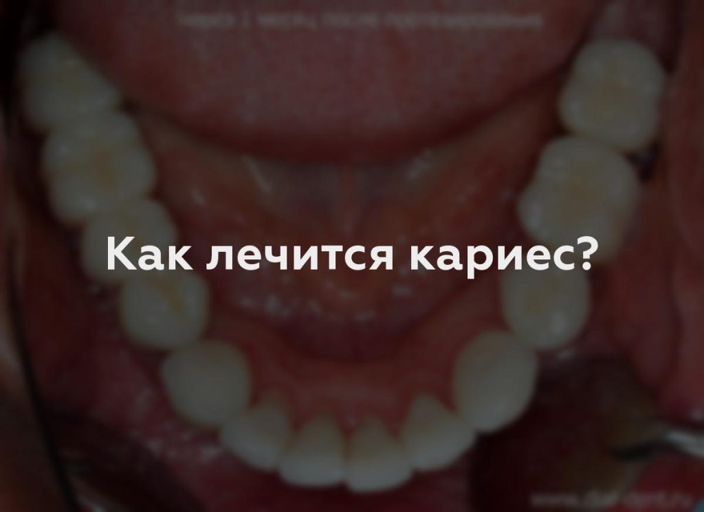 Как лечится кариес?