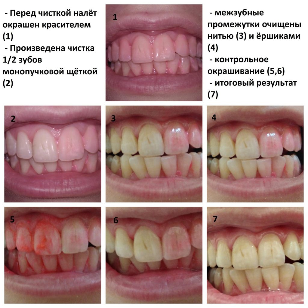 Как понять что ты хорошо почистил зубы?