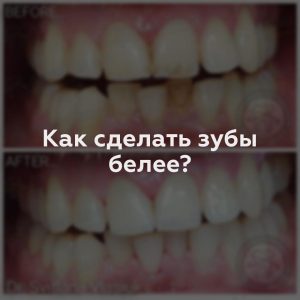 Как сделать зубы белее?