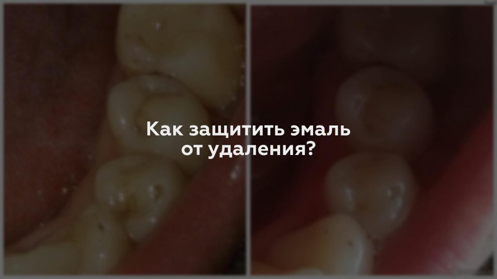 Как защитить эмаль от удаления?