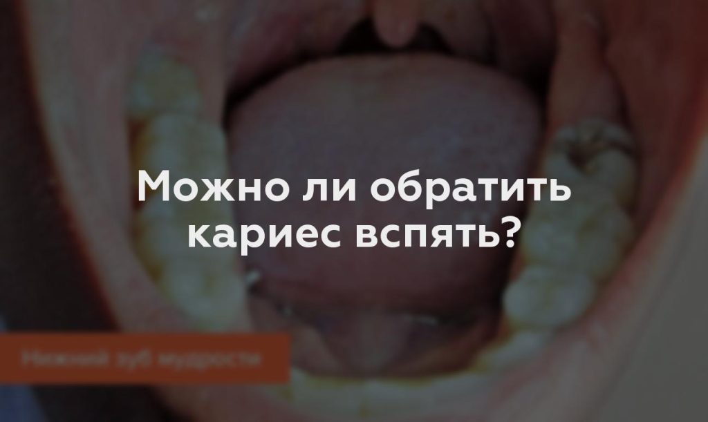 Можно ли обратить кариес вспять?