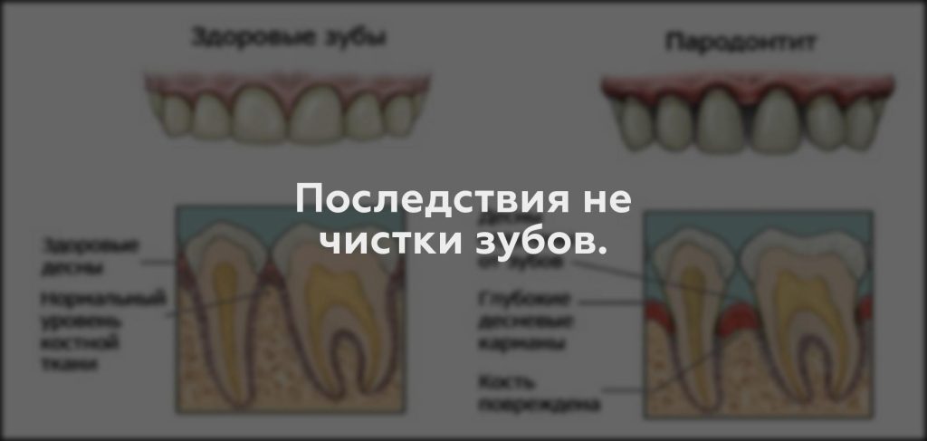 Последствия не чистки зубов.