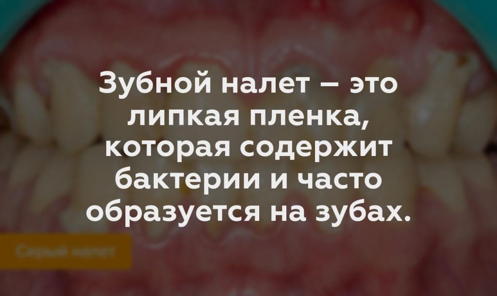 Зубной налет – это липкая пленка, которая содержит бактерии и часто образуется на зубах.