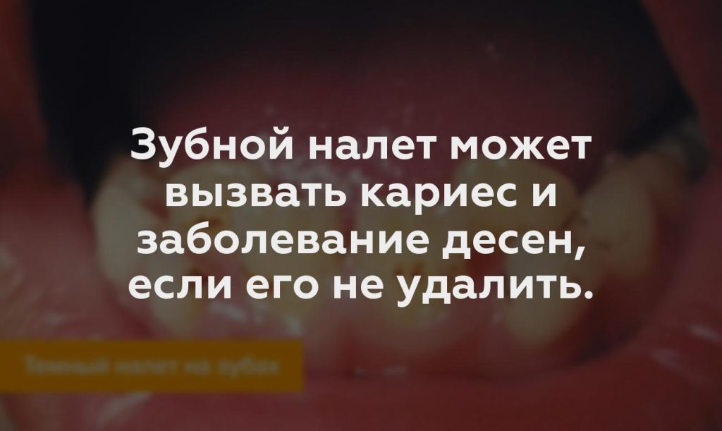 Зубной налет может вызвать кариес и заболевание десен, если его не удалить.