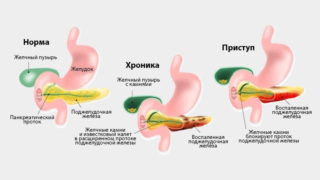 Чем опасна повышенная амилаза в крови?