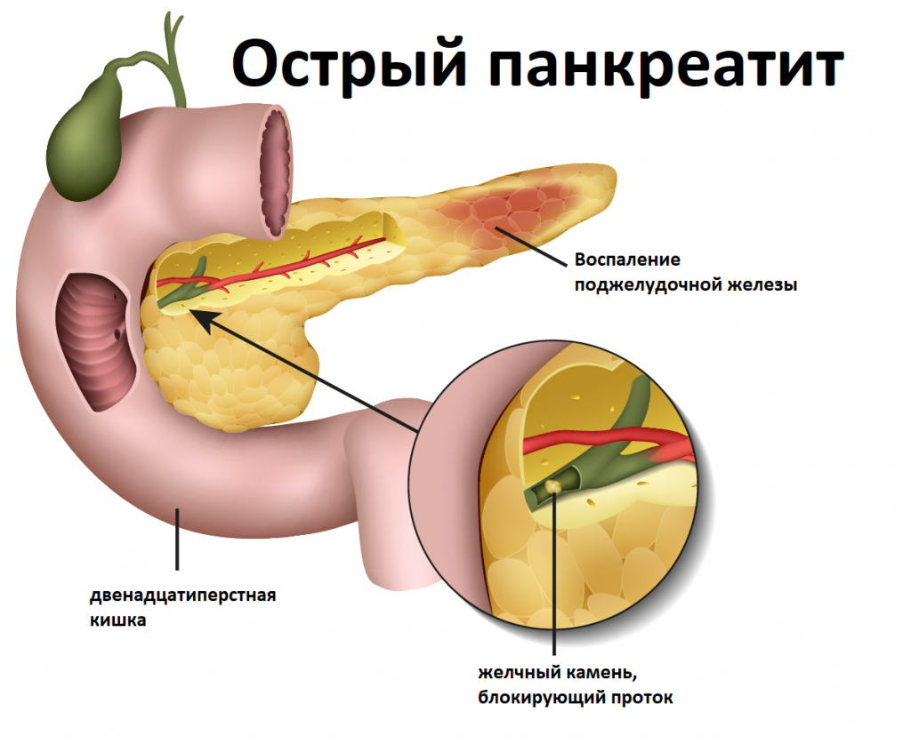 Что покажет УЗИ при панкреатите?