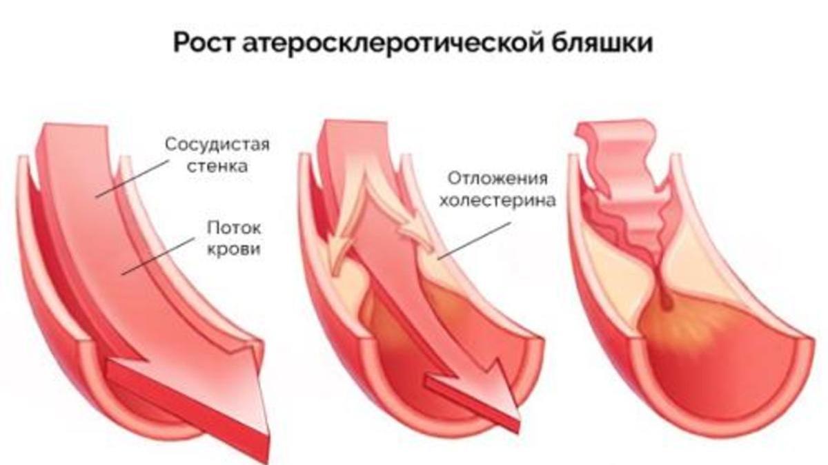 Как можно очистить кровь от холестерина?