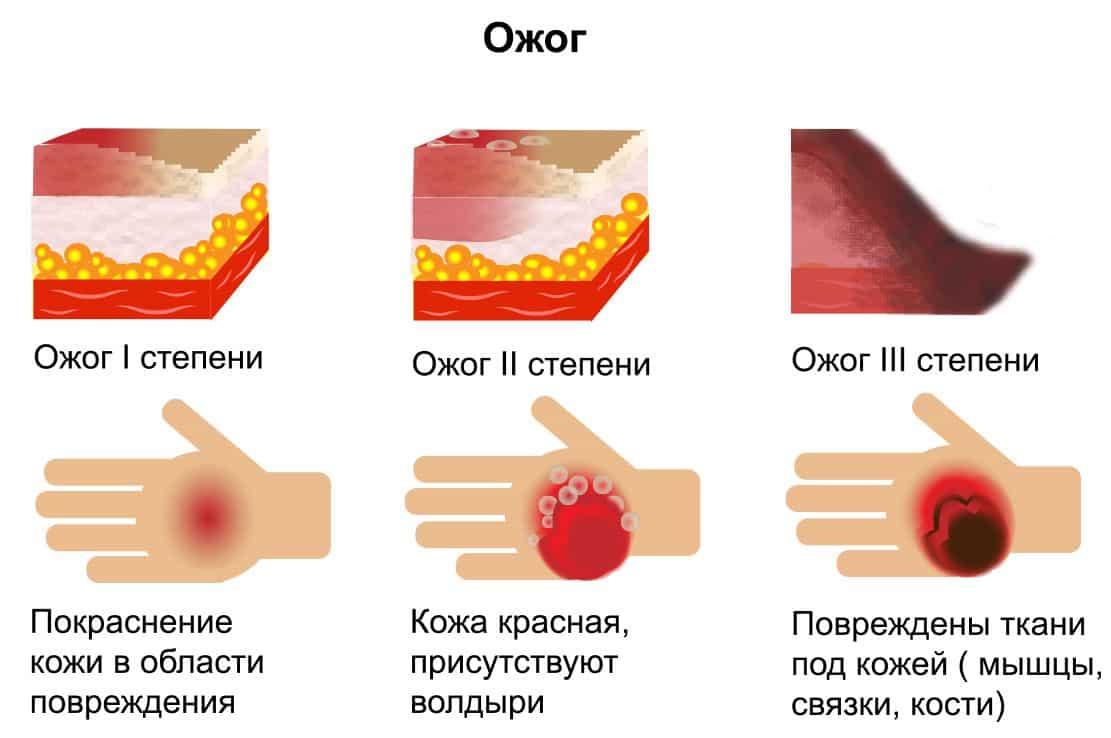 Как понять что получил ожог глаза?