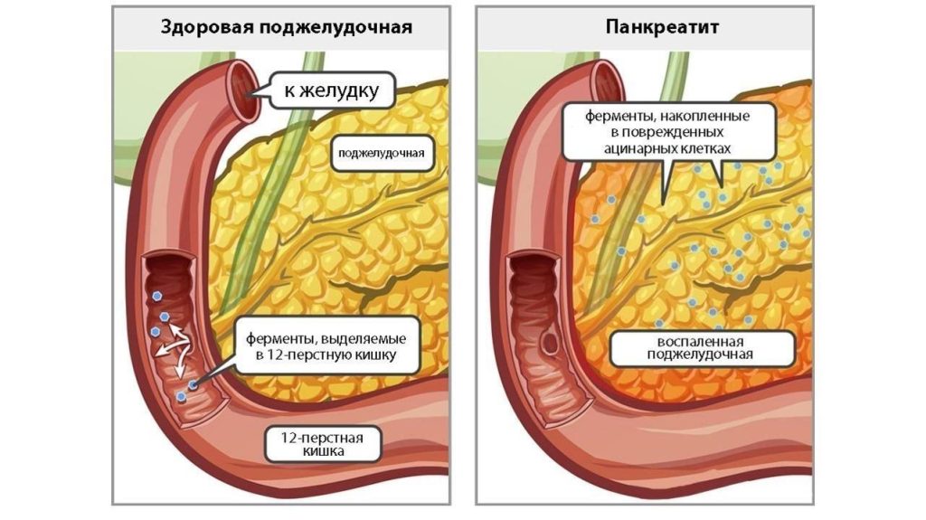 Как выглядит стул при панкреатите?