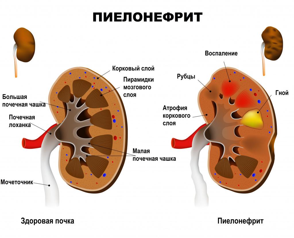 Какая моча при почечной недостаточности?