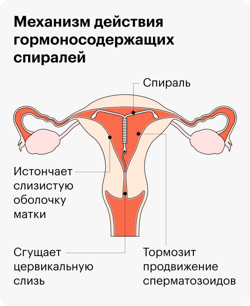 Можно ли забеременеть при мирене?