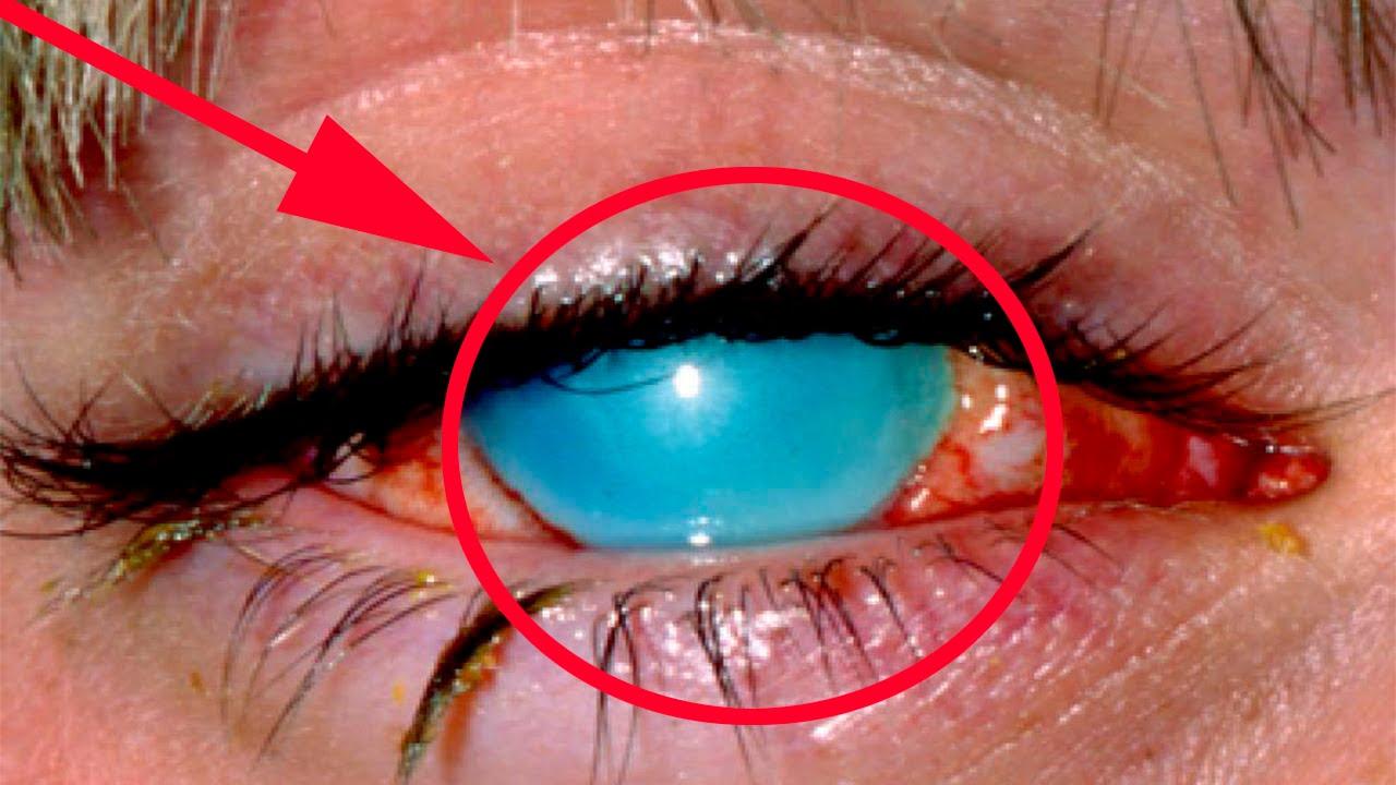 Сколько проходят глаза от сварки?