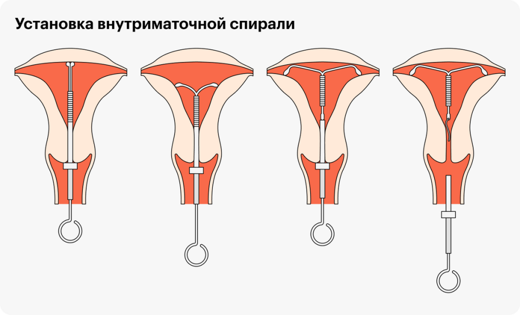 В каком возрасте нельзя ставить спираль?