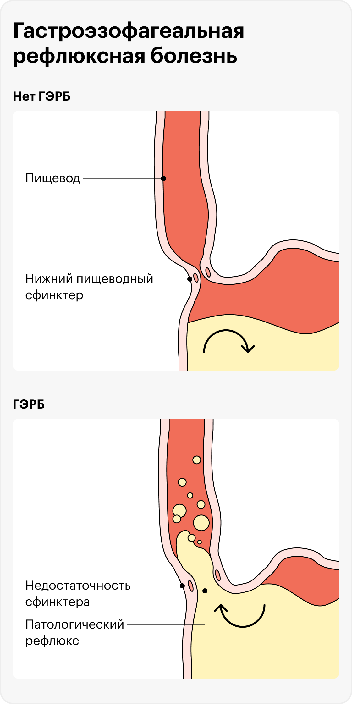 Почему изжога от кефира